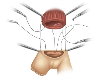 End-to-side esophagojejunostomy