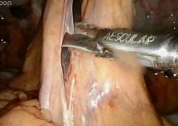 Tubular Dissection of the mesosigmoid