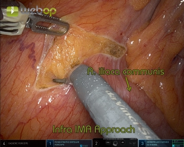 Vessel transection 2