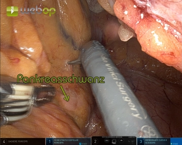 Mobilization of the left flexure from medial