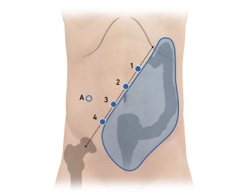 Creation of the capnoperitoneum, trocar positioning and docking