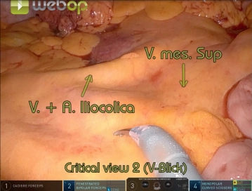 Preparation of the ileocolic vessels