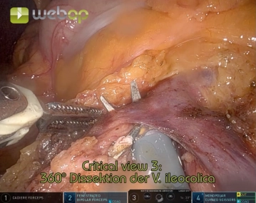 Transection of the ileocolic vessels 2