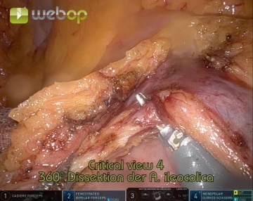 Transection of the ileocolic vessels 1