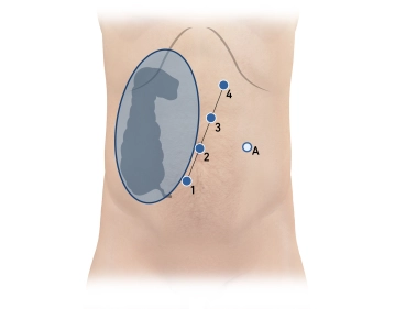 Trocar positioning and docking 1