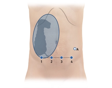 Trocar positioning and docking 2