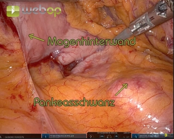 Opening of the bursa / Presentation of the upper border of the pancreas