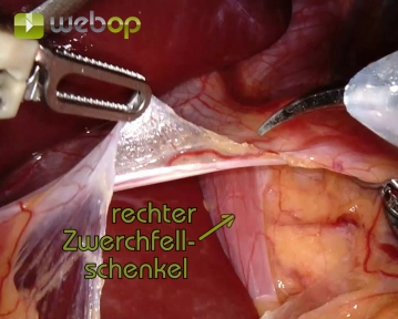 Tensioning the Stomach and Incising the Lesser Omentum