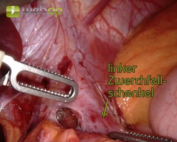Preparation of the Diaphragmatic Crura and Mediastinal Entry