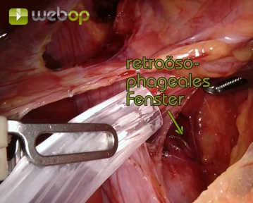 Encircling the Distal Esophagus