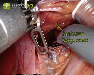 Preparation of the Posterior Commissure and Distal Esophagus