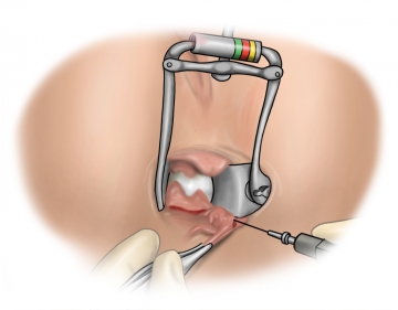 Excising the fissure and secondary changes