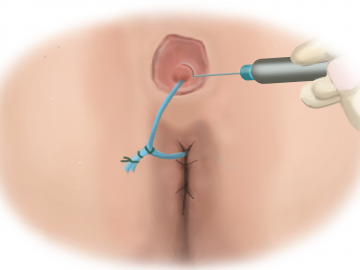 Excising the external fistula opening
