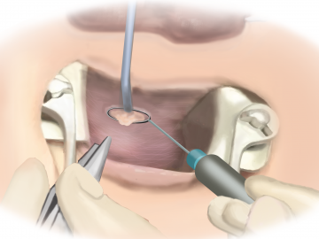Excising the internal fistula opening