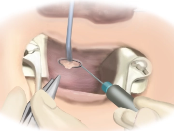 Excision of the Internal Fistula Opening