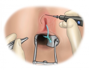 Excising the external opening of the fistula