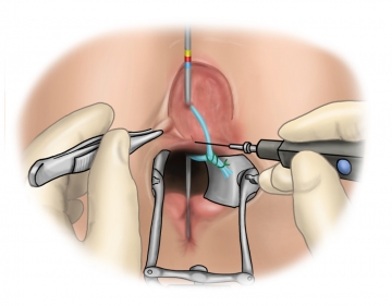 Dividing the anal sphincter