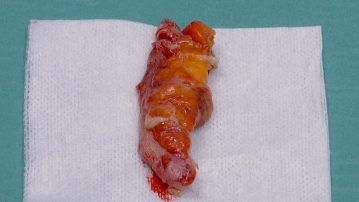 Extraction of the retrieval bag