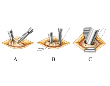 Trocar positioning