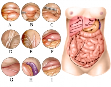 Instruments, minilaparotomy