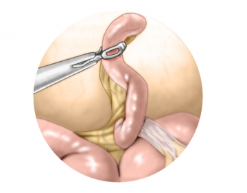 Pneumoperitoneum, exploration