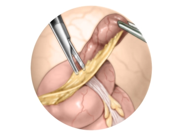 Transection of the mesentery