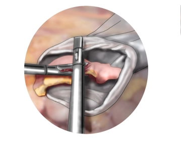 Retrieval of the appendix, swabbing of the Douglas pouch