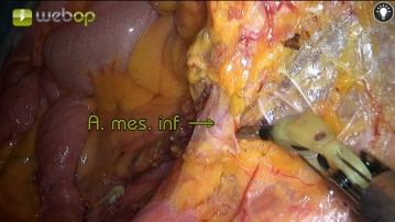 Präparation und Durchtrennung der Arteria mesenterica inferior 