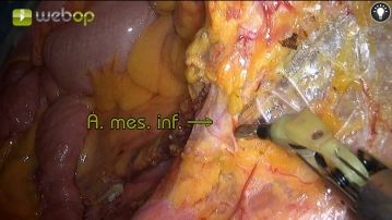 Präparation und Durchtrennung der Arteria mesenterica inferior 