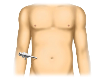 Positioning, skin incision, pneumoperitoneum