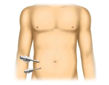 Insertion of the optic and working trocars