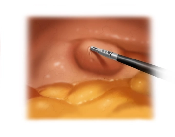 Inspection of the hernia orifice