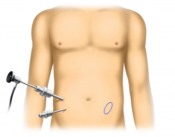 Determining the size and position of the hernia orifice