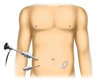 Determine the size and location of the hernia defect