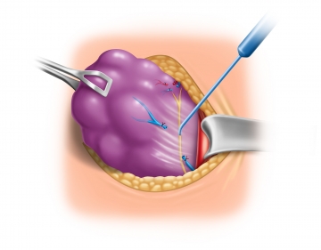 Darstellung des Nervus laryngeus recurrens