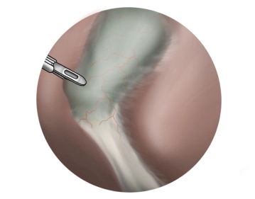 Fijación del infundíbulo