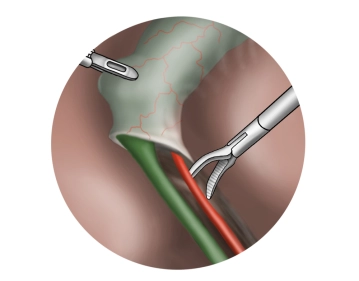 Preparación del conducto cístico y la arteria cística