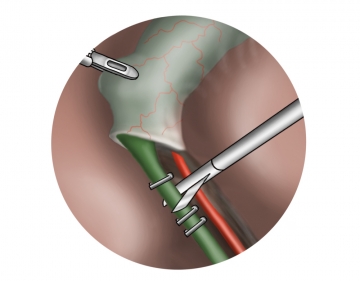 Durchtrennen des Ductus cysticus