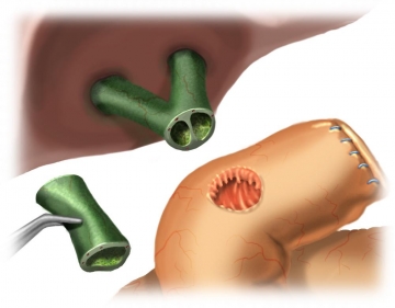 Preparation and transection of the common bile duct