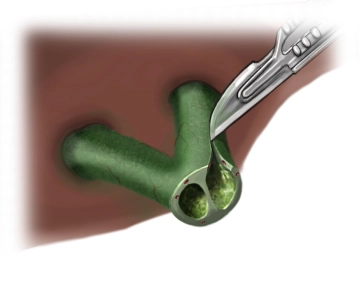 Extension of the Left Bile Duct According to Hepp-Couinaud