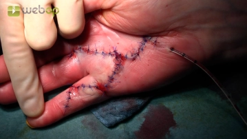 Irrigation and Wound Closure