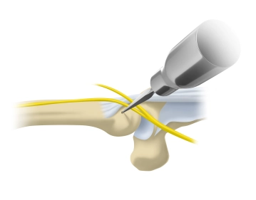 Opening of the medullary cavity