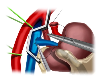 Realización de la anastomosis venosa