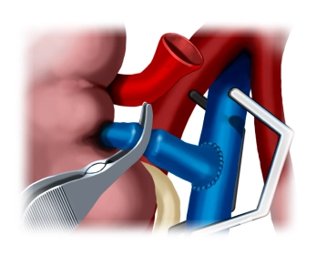 Prueba de estanqueidad de la anastomosis venosa