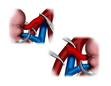 Realización de la anastomosis