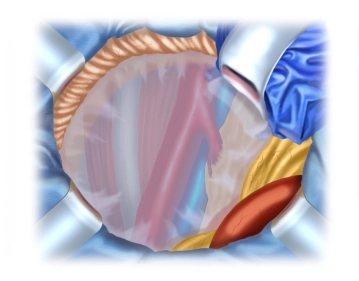 Exposición del retroperitoneo