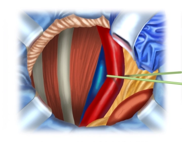 Preparación de los vasos ilíacos