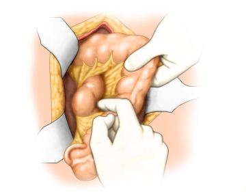 Dissecting the duodenum