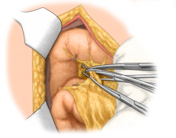 Dissecting the peripancreatic lymph nodes