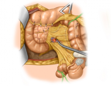 Dividing the ileocolic artery and vein